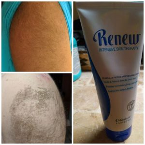 Toxin Free for Acanthosis nigricans